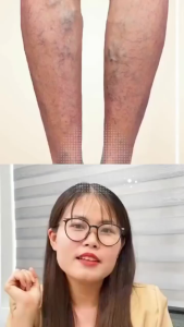 Miếng Dán Giãn Tĩnh Mạch Varicose Relief 12 Miếng – Hỗ Trợ Giảm Đau Sưng Phù Cải Thiện Gân Xanh