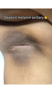 LYDIMOON Neck whitening neck wrinkle removal Body Whitening Cream underarm whitening cream armpit underarm knees buttocks private parts thigh Permanent whole body whitening 50g/box