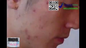 YULIN Acne Spot Cream 30g | Salep Totol Jerawat Ampuh Atasi Jerawat Beruntusan dan Memudarkan Bekas Jerawat [BPOM]-Acne Treatment Cream-Acne Care Cream-obat totol jerawat-penghilang jerawat-cream jerawat dan bekas jerawat-skincare acne untuk jerawat