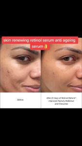 🟧PAYDAY SALE🟧CeraVe Skin Renewing Retinol Serum 30ml Anti-Aging Essence Smoothing Lines Wrinkles