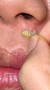 SimplyHeal Sulphur Patch | Day & Night Premium Hydrocolloid Acne Patch | Pimples Treatment with Sulphur Cica & Tea Tree Oil