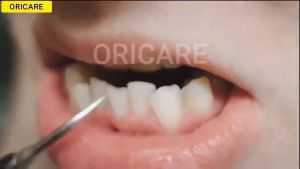 JGMALL เครื่องขูดหินปูน ที่ขูดหินปูน ขัดฟันไฟฟ้า clean teeth ขจัดคราบหินปูน ฟอกฟันขาวแท้ เครื่องขูดหินปูน ฟันผุ ขูด หิน ปูน ไฟฟ้า lectric Dental Scaler Tooth ขจัดคราบหินปูน หินปูนเกาะฟัน กำจัดหินปูนฟัน ทำความสะอาดสิ่งสกปรกที่ตกค้างในช่องปากอย่างล้ำลึก - Lazada