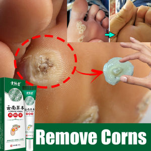 warts removal cream 20g ubat ketuat tapak kaki skin tag wart remover foot corn remover