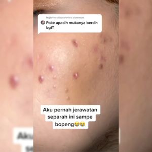Larissa Acne Lotion | Obat Jerawat