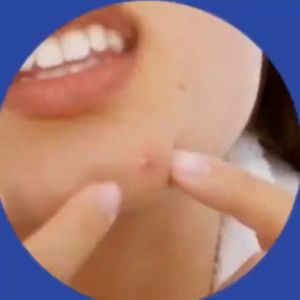 72x Acne Microneedles Patch Pimple Hydrocolloid Stickers Spot Cover Treatment