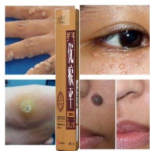 Kem bôi mụn thịt MỤN nốt duồi mụn cóc  mụn cơm nám tàn nhang hết bay nhanh trong nốt nhạc 5ML