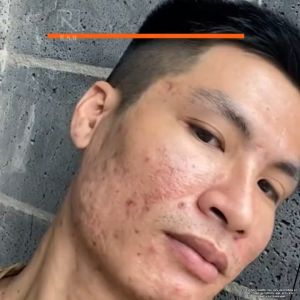 (ORIGINAL) RAU serum jerawat belubang untuk lelaki terbaru 2025 acne fading serum for Reduce Pitted Acne Scars Nourish skinMoisturizing Soothing Restores skin supports Melembutkan Mencerahkan kulit Memudarkan ParutJerawat Untuk lelaki Readystock