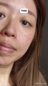 Noreva Exfoliac Global X-pro Care 30ml (For Moderate To Severe Acne & Marks)