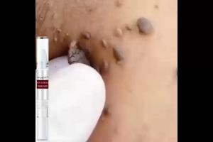 WIPEOFF TAGS  MOLES REMOVER tag and wart remover milia remover  wart removal ointment cream warts remover original kasoy oil warts remover moles remover pen painless mole facial body hand freckle wart dark spot skin blackhead remover
