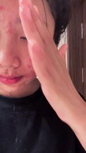 Acne removing printing and pockmarks removing and scar removing gel acne removing and pit repairing cream male and female acne elixir Anti acne cream anti acne anti swelling anti acne and anti acne essence