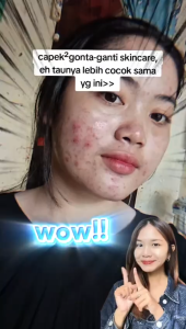 [New Packaging] KYMM SKIN Acne Spot Gel | Efektif Mengatasi Jerawat Wajah dan Bekasnya | Perawatan Muka Facial Treatment Berjerawat with Salicylic Acid