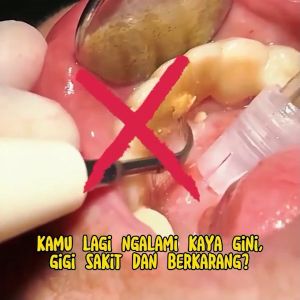 pemutih gigi kuning-pemutih gigi perontok karang gigi ampuh Teeth-pemutih gigi permanen asli-pasta gigi pemutih-pemutih gigi permanen asli-obat karang gigi perontok-obat pemutih gigi-pemutih gigi teeth powder-pemutih gigi*memutihkan gigi