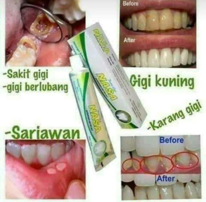 Pasta gigi penghilang gigi kuning,karang gigi, sariawan | Lazada Indonesia