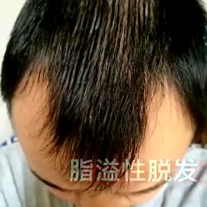 Hair Growth Serum Anti Hairloss Solution Hair Root Booster 30ml Anti dandruff Effectively Prevent hair loss Increase hair volume Treatment 去屑防脱发育发液