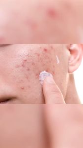Clorismen Acno Gel Acne Spot Treatment untuk wajah  Jerawat Beruntusan Bintik Merah Di Wajah Pria