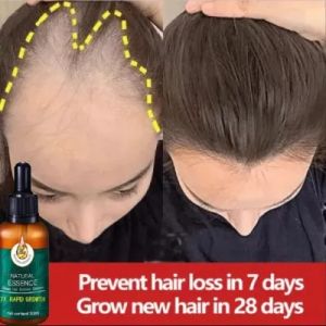 EELHOE Hair Growth Serum PENUMBUH RAMBUT Cairan Serum Penumbuh Rambut Anti Rontok /Obat Rambut Botak / Serum Penumbuh Rambut Botak / Penumbuh Rambut Botak / Obat Penumbuh Rambut Botak Pria / Rambut Rontok Parah / Rambut Rontok Penyubur 30Ml