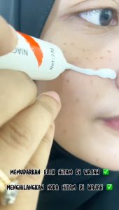 [BPOM APPROVE] CINDYNAL Whitening  Niacinamide Skin Cream Remove  - Penghilang /Jerawat/Bintik Noda Hitam Komedo