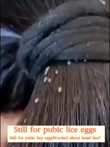 100mL Licealiz Head Lice Treatment Shampoo: Effective Lice Removal Solution