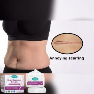 OUHOE ครีมรอยแผลเป็น ครีมลบรอยแผลเป็น  ลดรอยแผลเป็น รอยแผลเป็นจากสิว และลบรอยแผลเป็นจากสิว Scar Care Scar Skin Care Moisturizing Smooth Skin Facial Care ครีม เอสเซ้นส์กำจัดรอยแผลเป็น (50g)