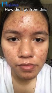 Skin Magical Rejuvenating Set 3 Pampaputi Whitening Exfoliating Moisturizing Beauty Skin Care Kojic Soap Facial Toner Night Cream Sunblock Sunscreen Pimple Acne Pores Blackheads Pekas Melasma Scar Dark Spot Anti Aging Hydrating Moisturizer For Men & Women