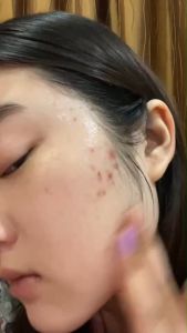 MeD ครีมมีดี แอคเน่บัสเตอร์เซรั่ม (เซรั่มสำหรับผิว ที่มีปัญหาสิว)