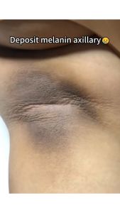 Private parts whitening cream Private parts care Joints Underarm whitening Vitamin C whitening cream Moisturizing Inhibit melanin production Decompose melanin