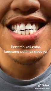 Misterdent brightening teeth MEMUTIHKAN DAN MENGHANCURKAN KERAK GIGI