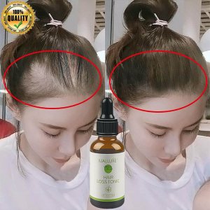 Original Hair Growth Serum Anti Hair Loss Hair Tonic hair growth oil 30ml Hair Fall Scalp serum rambut 6 times Hair Growth hair care Rambut Gugur Rambut Gugur 6X Lebih Cepat - Lazada
