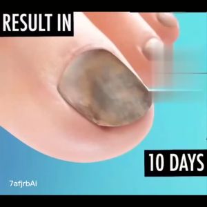 Aegnic nail repair solution Nail fungus infection onychomycosis Ingrown toenails Ony chomycosis Cracked nail care fungal nails Black nails Brittle nails Manicure nails Nail polish Nail Nail care Nail polish Anti-Ony chomycosis Nail polish liquid