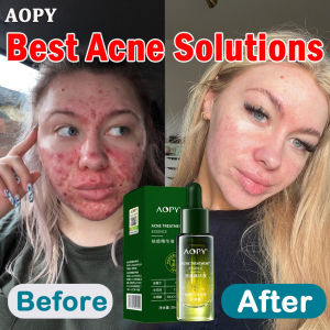Acne Serum Salicylic Acid Serum 30ml Anti acne & Acne scar removal Repair acne pits Moisturizing hydrating serum Pore Minimizer Firming Whitening Anti-Aging