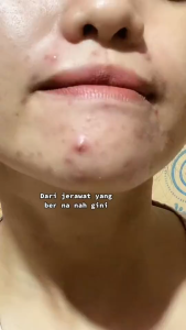 set 2 gói Miếng dán Hỗ trợ giảm mụn ban ngày & đêm cho mặt Nhẹ nhàng & Thoải mái