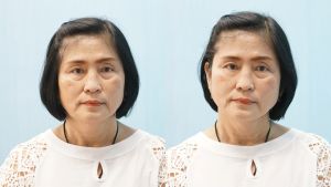 ของแท้ 100% Reskin เซรั่มบำรุงรอบดวงตา ตีนกา ร่องแก้ม ร่องหน้าผาก