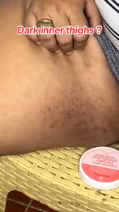 【🇸🇬Ready 】Inguinal Whitening cream whitening body remove melanin brighten skin tone Take effect quickly 25g