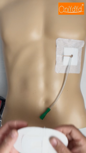 Peritoneal Dialysis Catheter Fixation Patch Waterproof Patch with Drainage Holes Patch Ostomy Protection