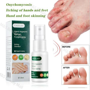 Anti-itch spray for hands and feet/nail repair spray/anti-crack/quick anti-itch/antibacterial skin moss/athletes foot and onychomycosis spray