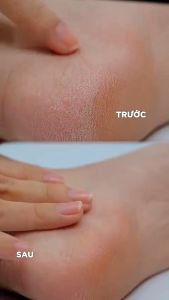 Kem nứt gót Oriss dưỡng ẩm làm mềm gót chân làm liền vết thương 30g