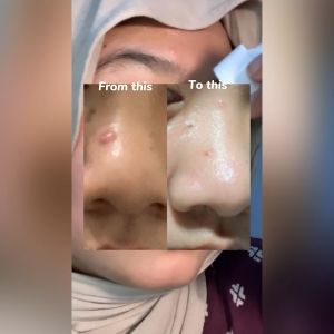 Cyskin Serum untuk Kulit Berminyak dan Berjerawat 20 ml I Acne Treatment Serum