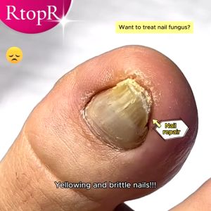 RtopR Ginger Antibacterial Nail Treatment Essential Anti Fungal Infection Toe Nursing Anti 10ml