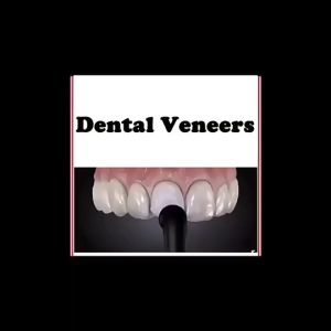30Pcs/Set Veneer Gigi Form Dental Cetakan Veneer Gigi Alat Pemutih Veneer Gigi