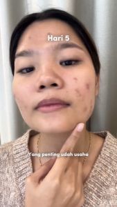 GBELLE Face Wash 3in1 Acne Moisturizing Brightening Cleansing Mousse Pembersih Wajah Mencerahkan Facial Wash Massage Kulit Berjerawat Iritasi Kemerahan G-Belle