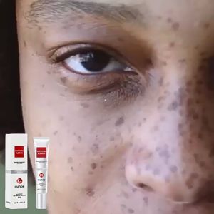 OUHOE Spot Removal Cream 20g Brightens Skin Reduces Dark Spots Improves Tone Moisturizes Nourishes