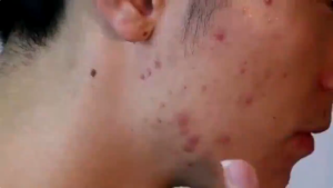 RAVINIA Face Anti Acne Gel Facial Acnes Removal 30g Eradicating Acnes and Pimples Refresh Skin Smooth