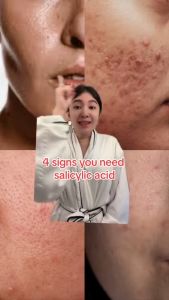 SKINEVER Salicylic Acid Acne Deep Cleaning Gentle Exfoliating Oil Control Acne Treatment Skin Care 4.9 10K+ ratings 10K+ Sold