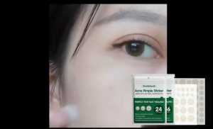 【BUY 1 TAKE 1】West Month Pimple Acne Patches – Hydrocolloid Acne Patch for Healing Skin Treatment Pimples Removal Facial Skin Care
