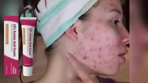 15% Azelaic Acid Cream Acne Treatment Pore Remover Sensitive Skin Barrier Repair Nicotinamide Vitamin C Blackhead Remover Cream