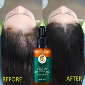Serum Pertumbuhan Rambut EELHOE: Meningkatkan Pertumbuhan Rambut & Mencegah Rontok