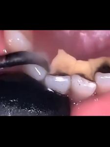 Electric Teeth Cleaner & Tartar Remover: A Comprehensive Guide