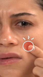 COD 36Pcs Acne Patch Sticker Jerawat Transparan Polos Untuk Harian Menutup Jerawat