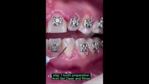 Dental Orthodontic Adhesive Kit Light Cure Glue Metal Ceramic Brackets Braces Invisible Bonding Dentistry Tools Dentist Material