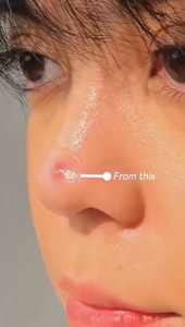 GLAD2GLOW Centella Salicylic Acid Day&Night Acne Patch